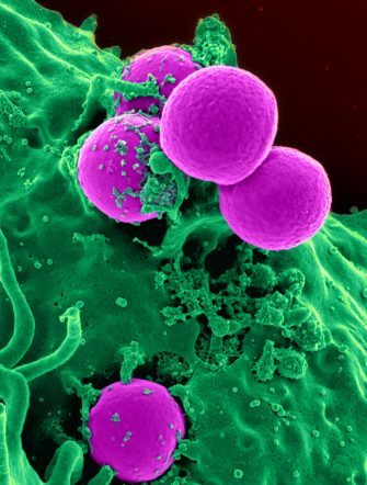 Health: Scientists Destroy HIV-Infected Cells In Lab
